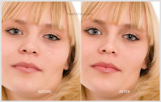 scar remove photo retouch