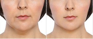 feminine chin line jaw shape