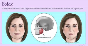 Injecting Botox weakens the muscles which lead to reduction of the tissue in the area making the facial feature slimmer