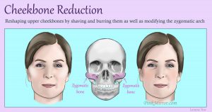reshaping the upper cheekbones by shaving and burring them as well as modifying the zygomatic arch