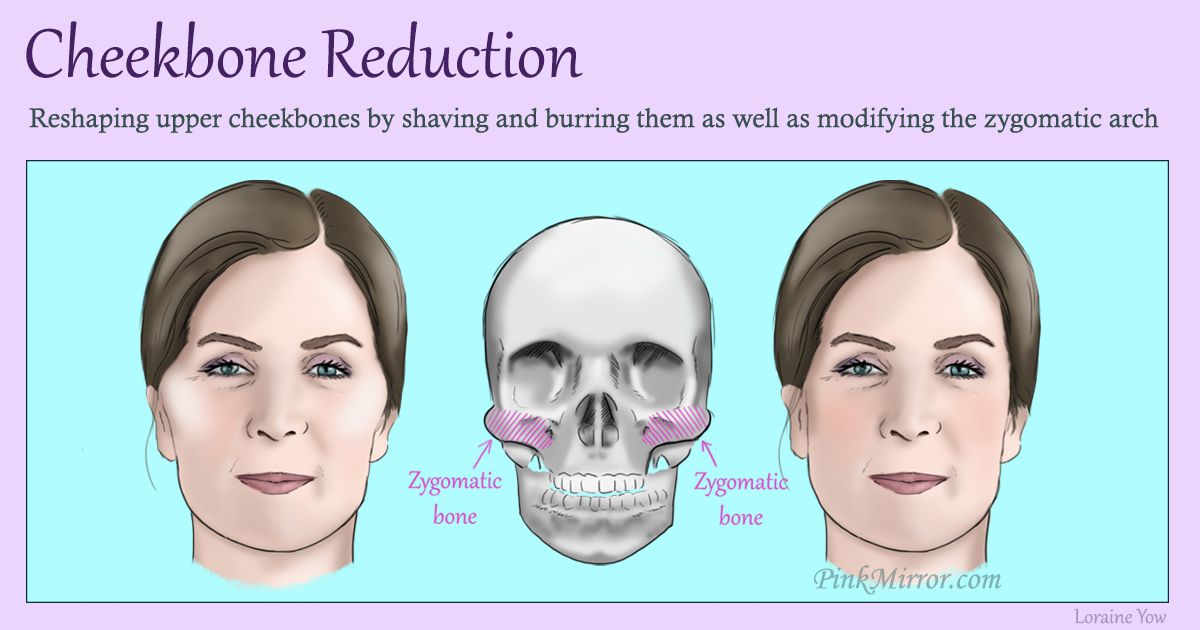 reshaping the upper cheekbones by shaving and burring them as well as modifying the zygomatic arch