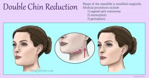 shape of the mandible is modified surgically by removing parts of bone and flesh near the chin