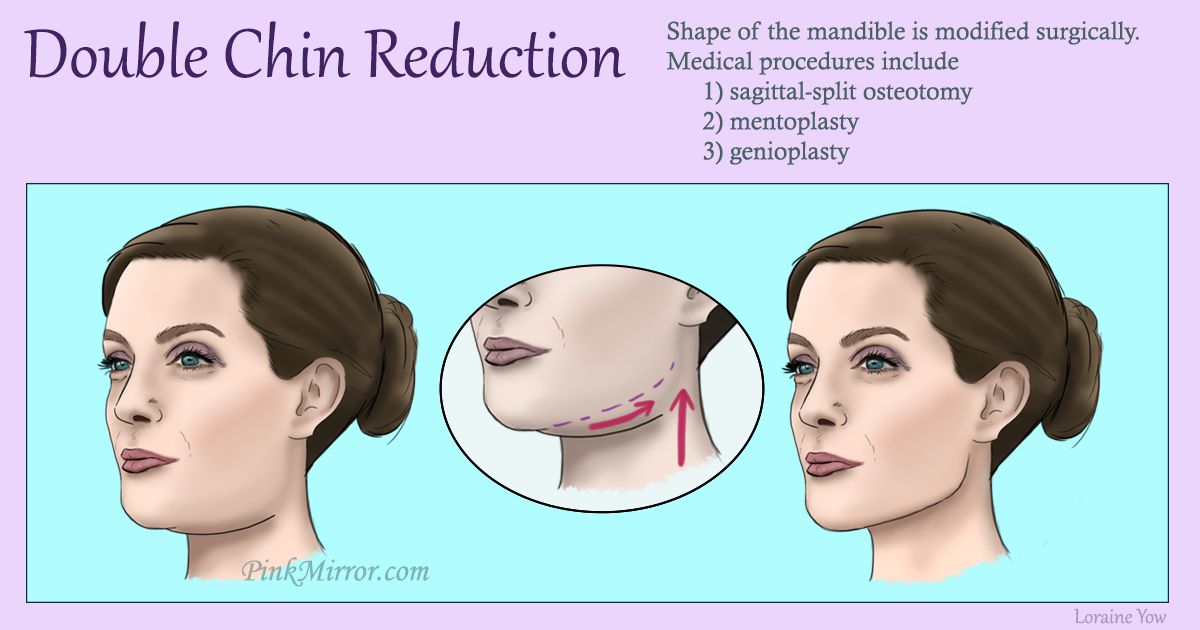 Double-Chin-Reduction – PinkMirror Blog