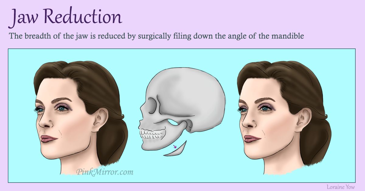 reducing the breadth of the jaw by surgically filing down the angle of the mandible