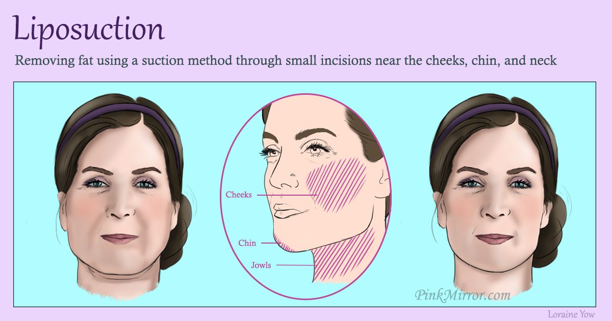 removing facial fat using a suction method through small incisions made near the areas where changes need to be made