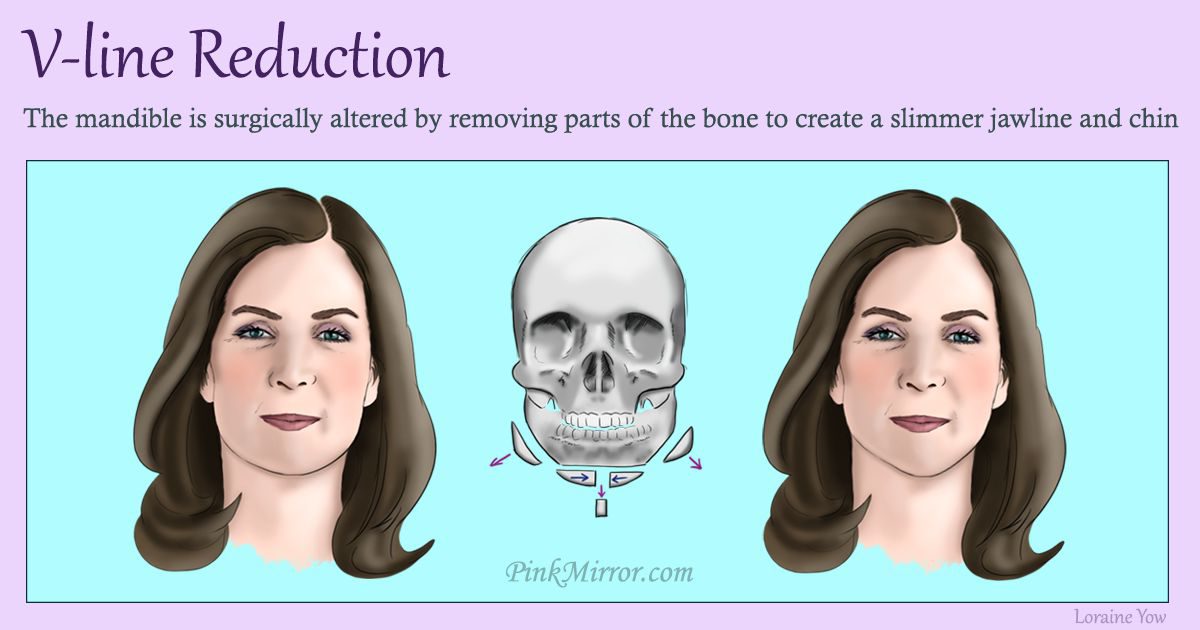 reforming the shape of the lower face to create a vertically narrower facial feature