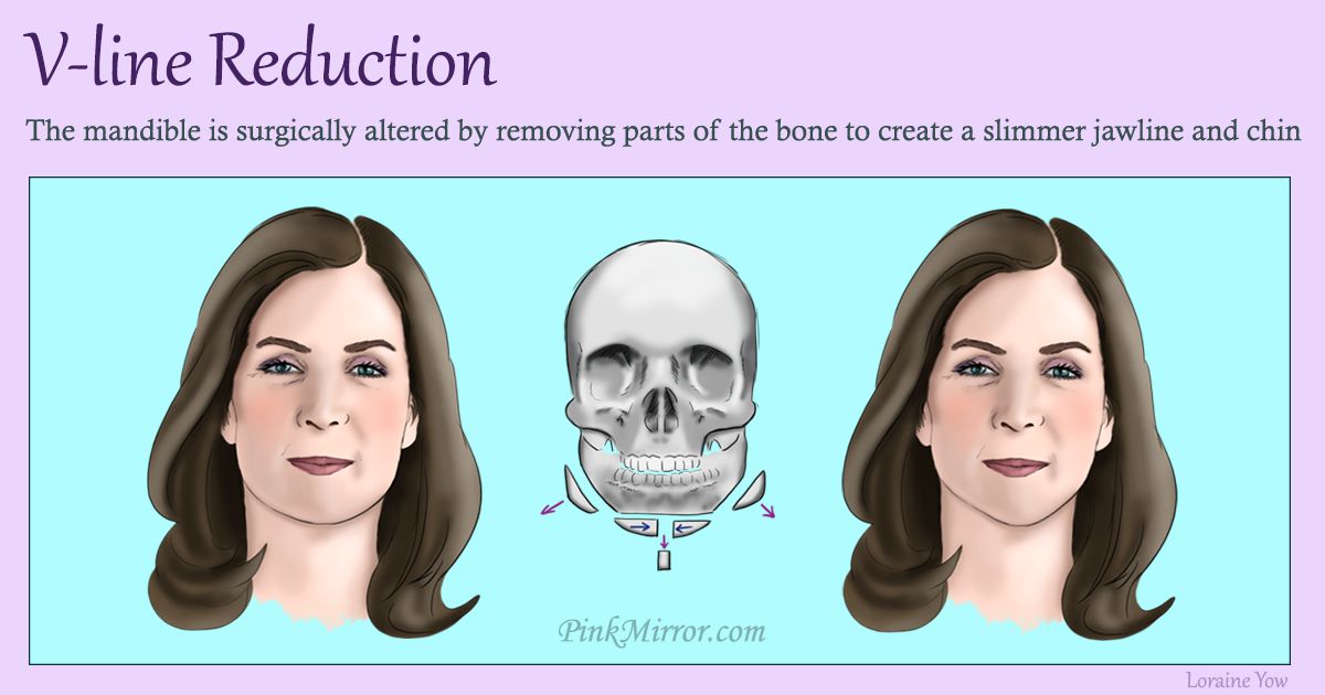 reforming the shape of the lower face to create a vertically narrower facial feature