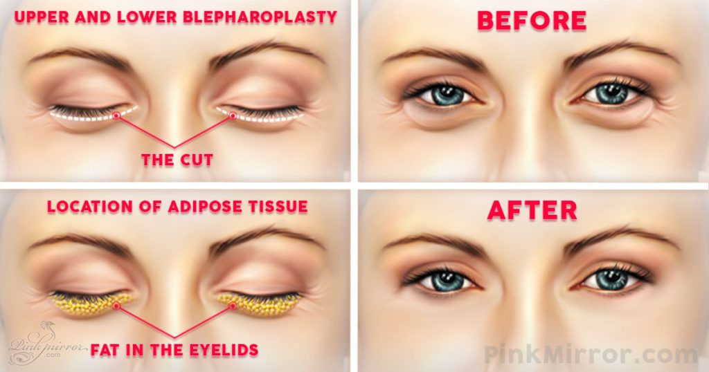 how to get rid of hooded eyes without surgery