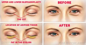 Surgery under eye bags Blepharoplasty eyelid lift