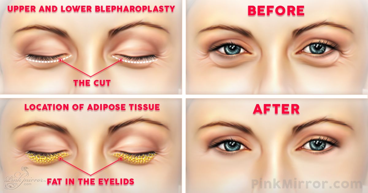 Surgery under eye bags Blepharoplasty eyelid lift