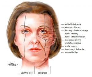 What is an Eye canthal Tilt? Why is a positive tilt more attractive ...