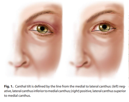 What is an Eye canthal Tilt? Why is a positive tilt more attractive ...